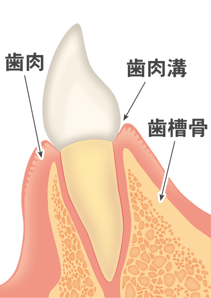 歯周病進行図1