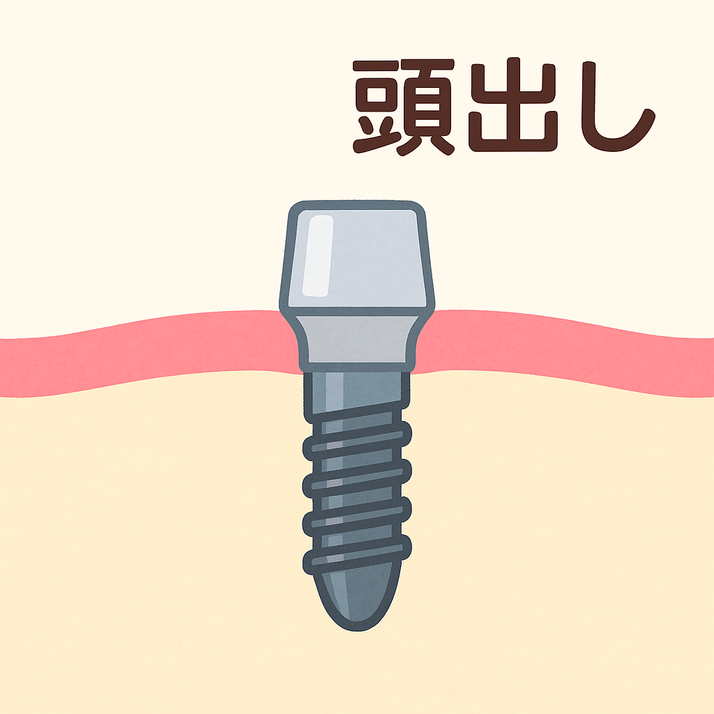 頭出し(アバットメント連結)