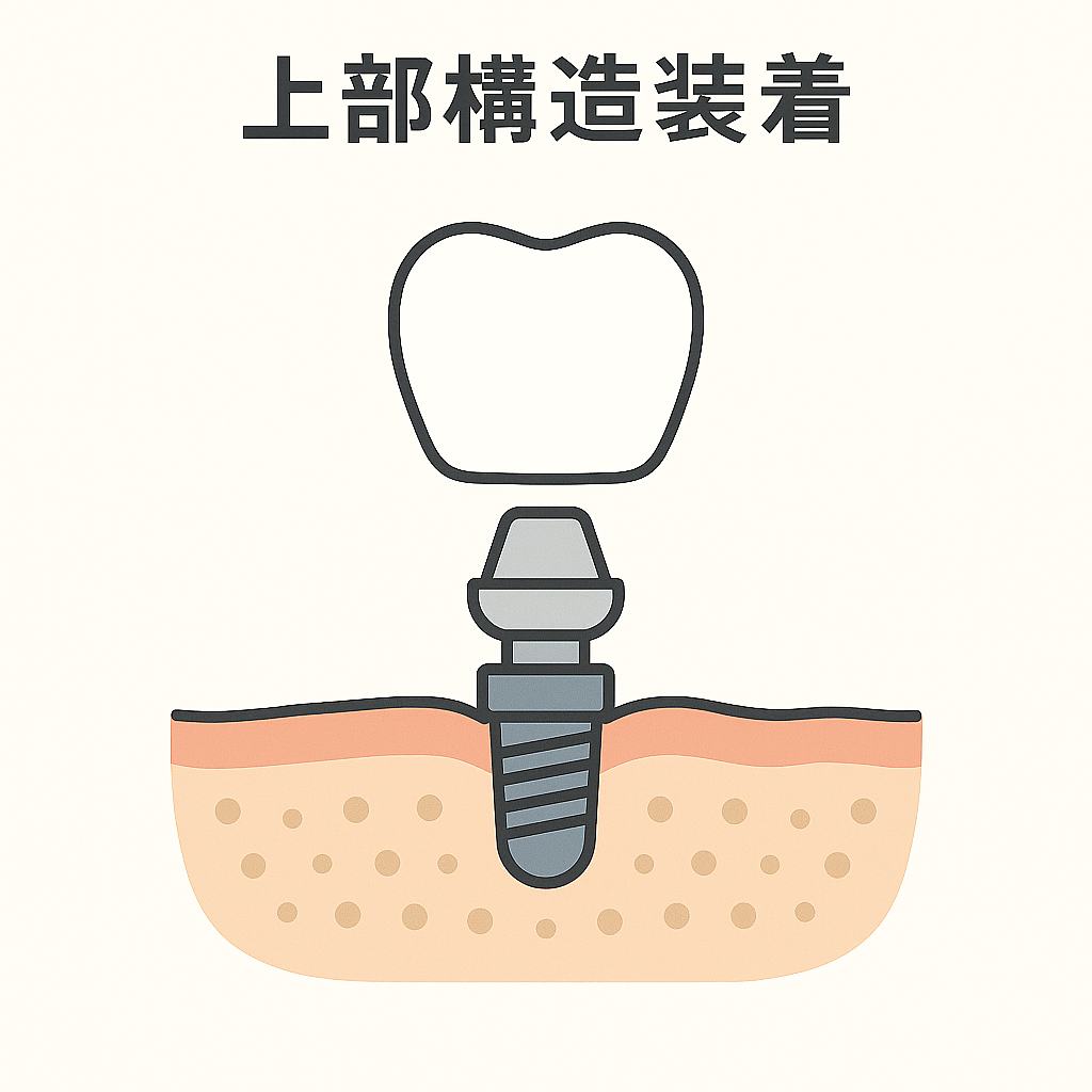 上部構造装着
